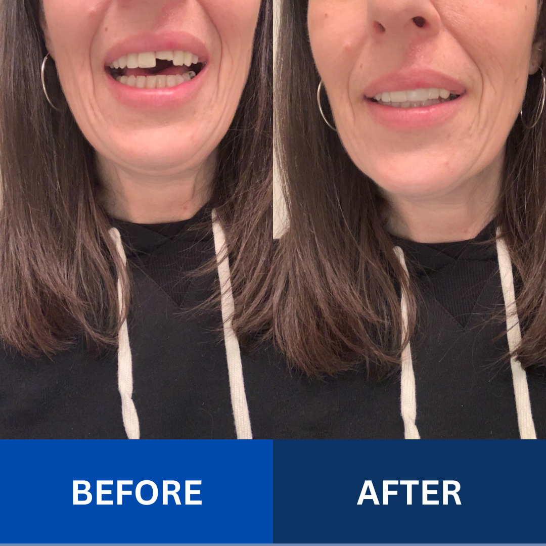 MendDental Smile Restoration Kit