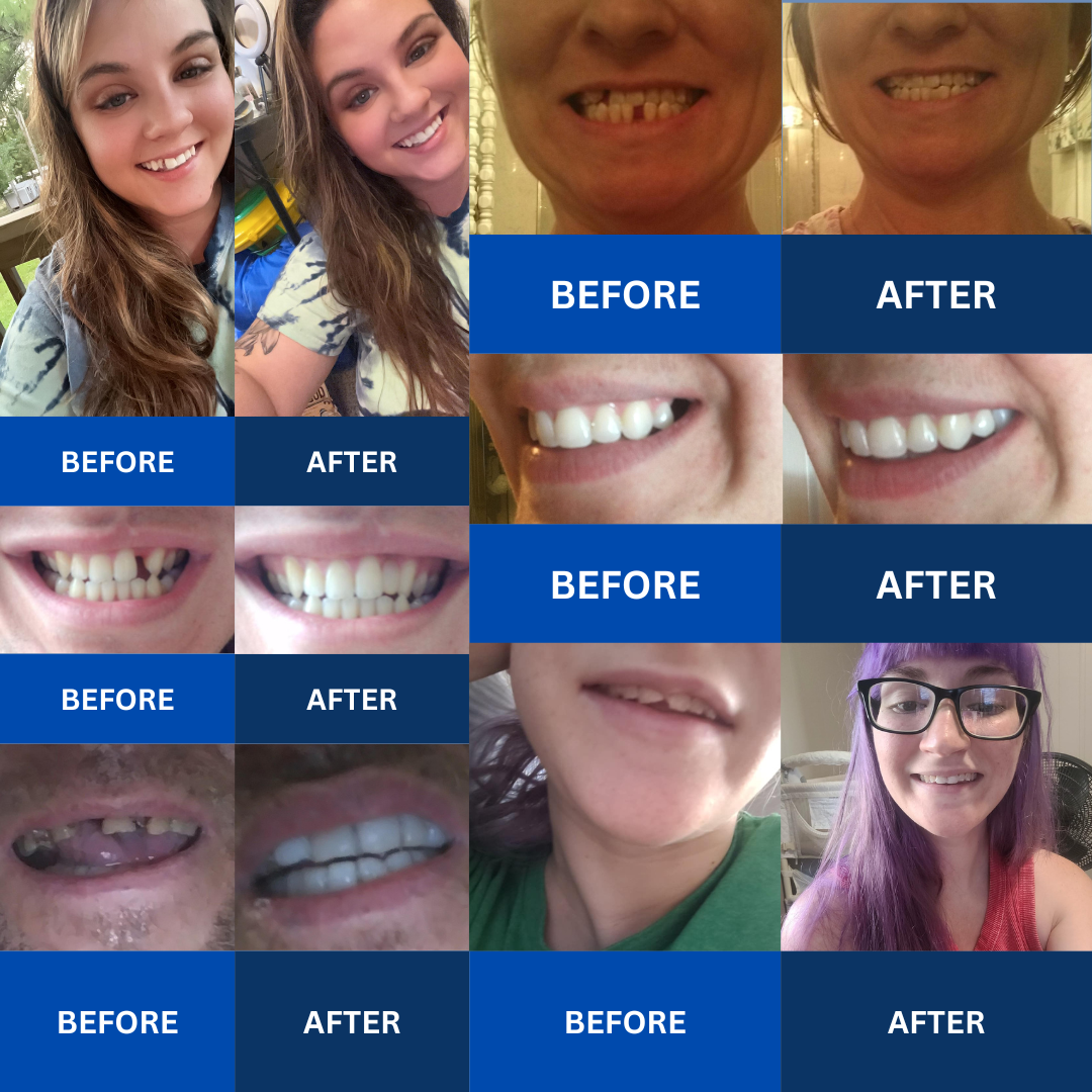 MendDental Smile Restoration Kit