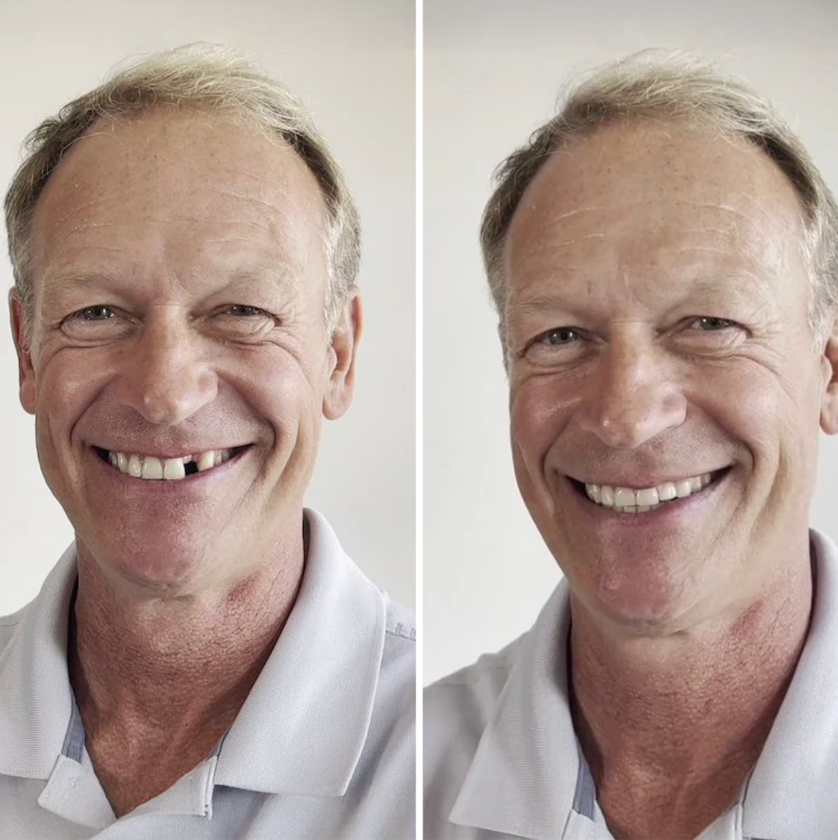 MendDental Smile Restoration Kit