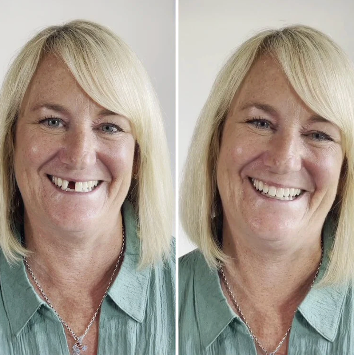 MendDental Smile Restoration Kit